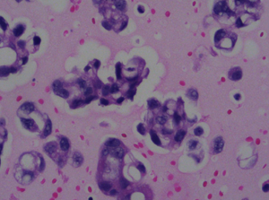 Pleural-Fluid-with-Metastatic-Cancer