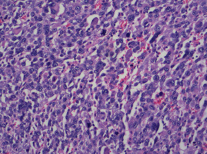 Soft-Tissue-Sarcoma